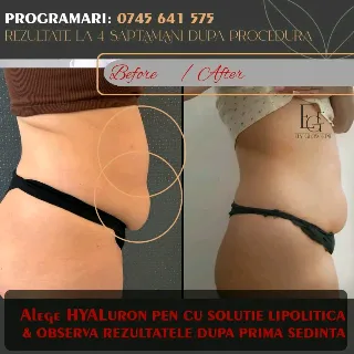 ✨ Hyaluron Pen: Remodelare fără ace!
​O procedură non-invazivă și rapidă care folosește presiunea pentru a introduce soluții lipolitice direct în țesut. Topește grăsimea localizată si reduce volumul.
