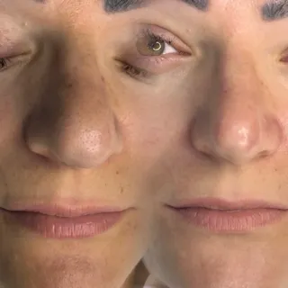Curățare tip Hydrafacial 