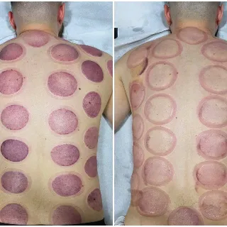 In stanga este după prima ședință de ventuze statice , în dreapta după a 6-a ședință. Un rezultat fabulos, client mulțumit ! 